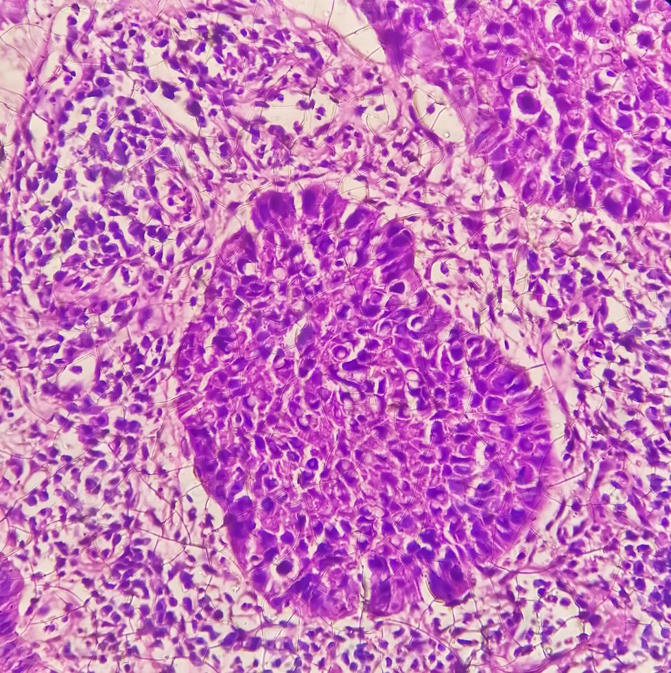 Photomicrograph showing tongue squamous cell carcinoma Grade II. Oral Invasive SCC. photo