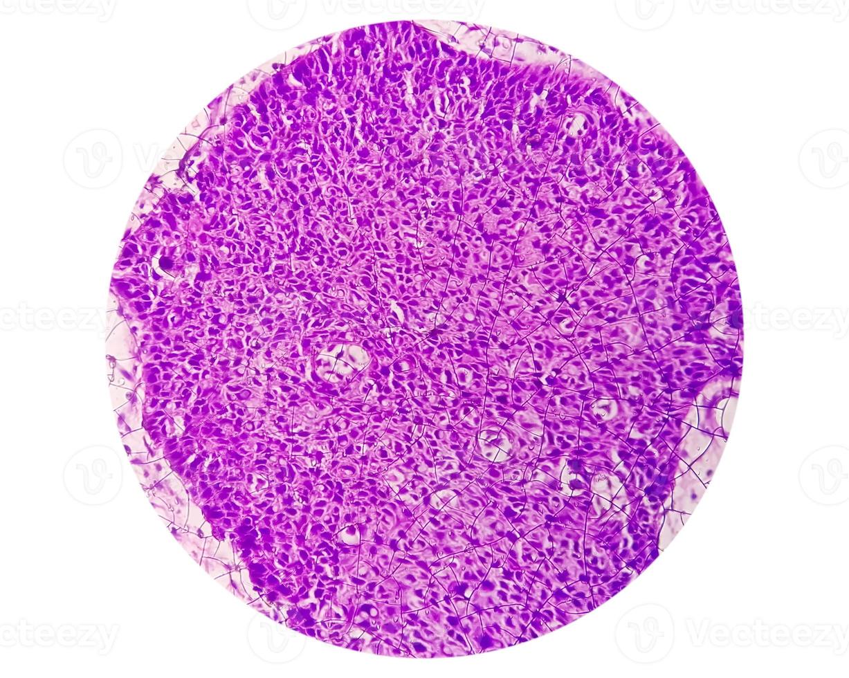 Photomicrograph showing tongue squamous cell carcinoma Grade II. Oral Invasive SCC. photo
