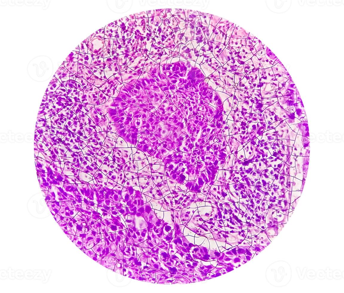 Photomicrograph showing tongue squamous cell carcinoma Grade II. Oral Invasive SCC. photo