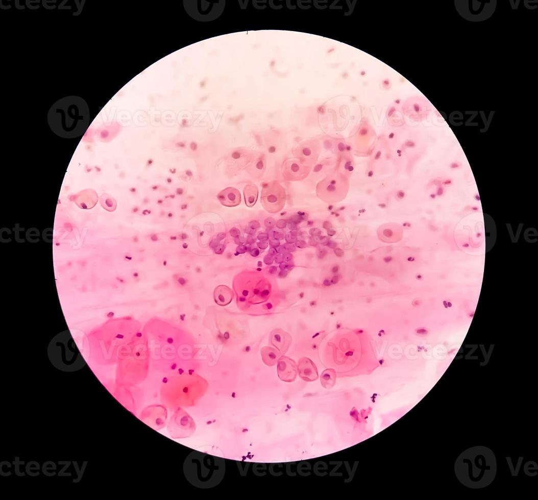 Paps smear under microscopy showing inflammatory smear with hpv related changes. Cervical cancer. SCC photo