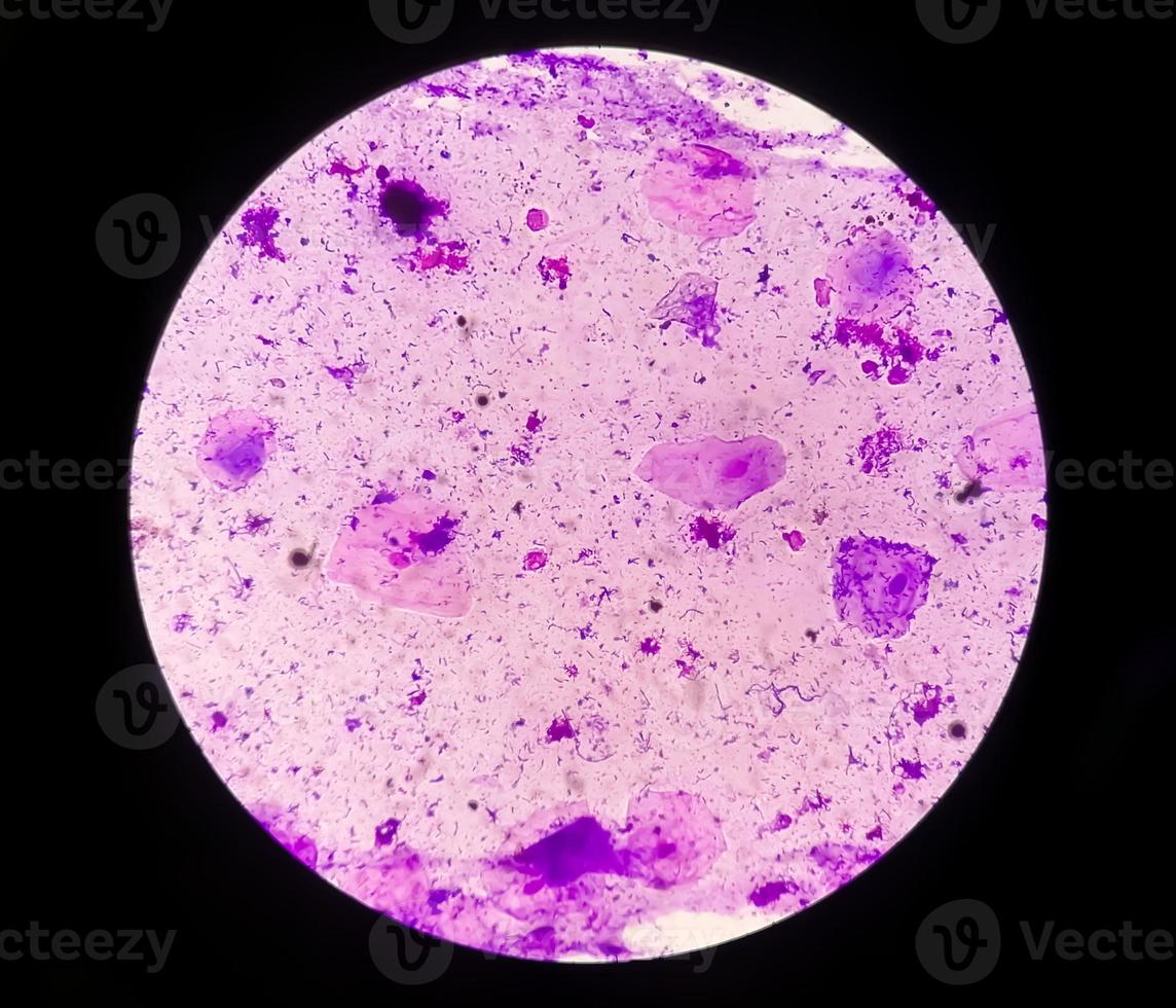 Gram stain of High vaginal swab, photomicrograph. photo