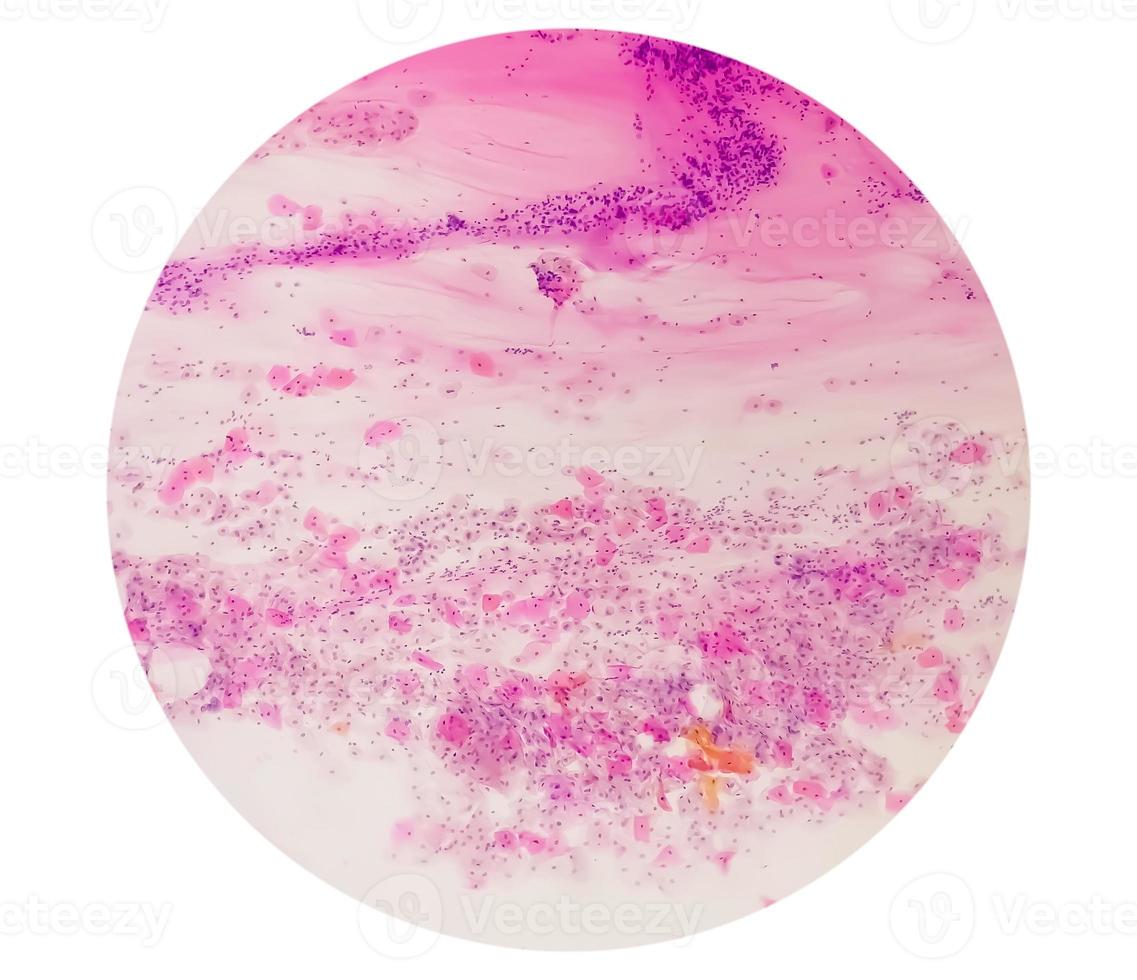 Paps smear under microscopy showing inflammatory smear with hpv related changes. Cervical cancer. SCC photo
