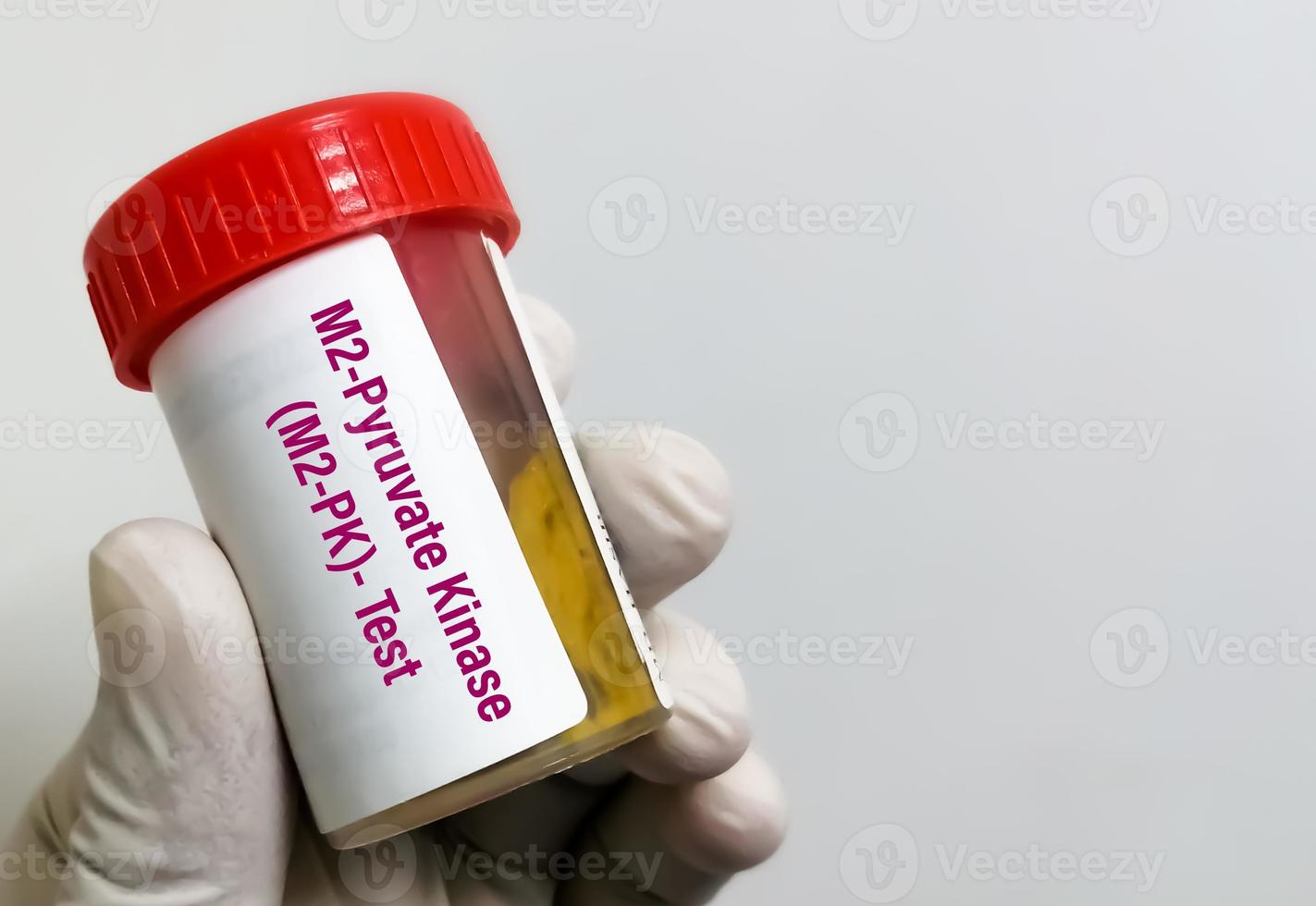 Stool sample for M2PK or M2pyruvate kinase Test, is a noninvasive