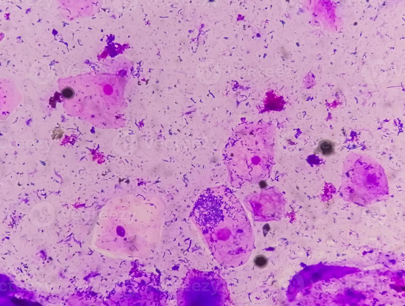 Gram stain of High vaginal swab, photomicrograph. photo