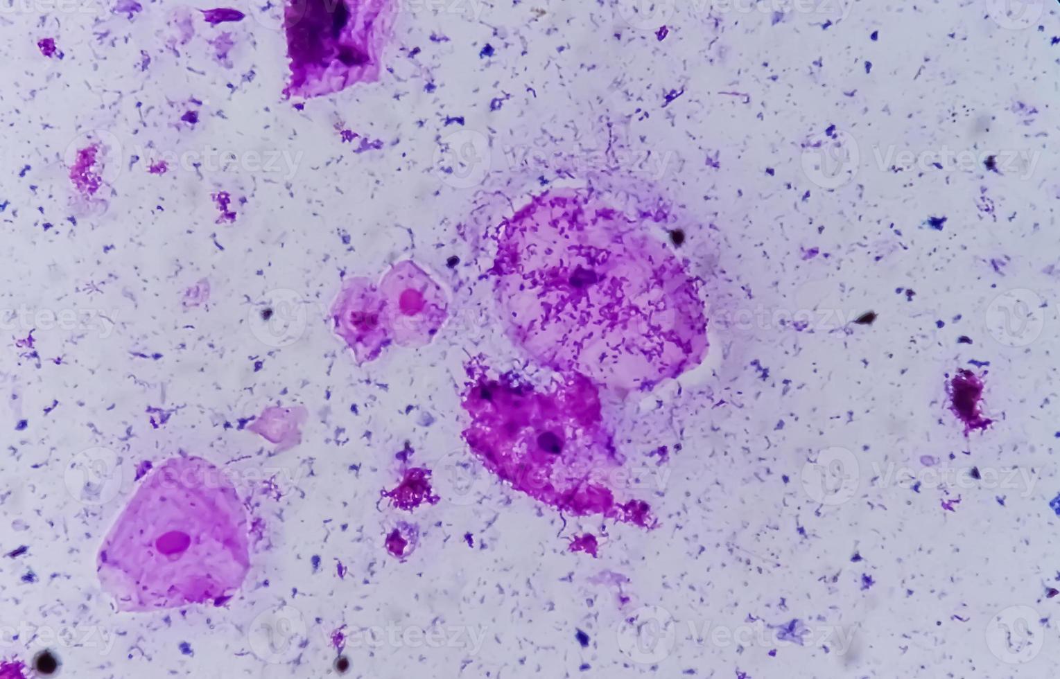 Gram stain of High vaginal swab, photomicrograph. photo