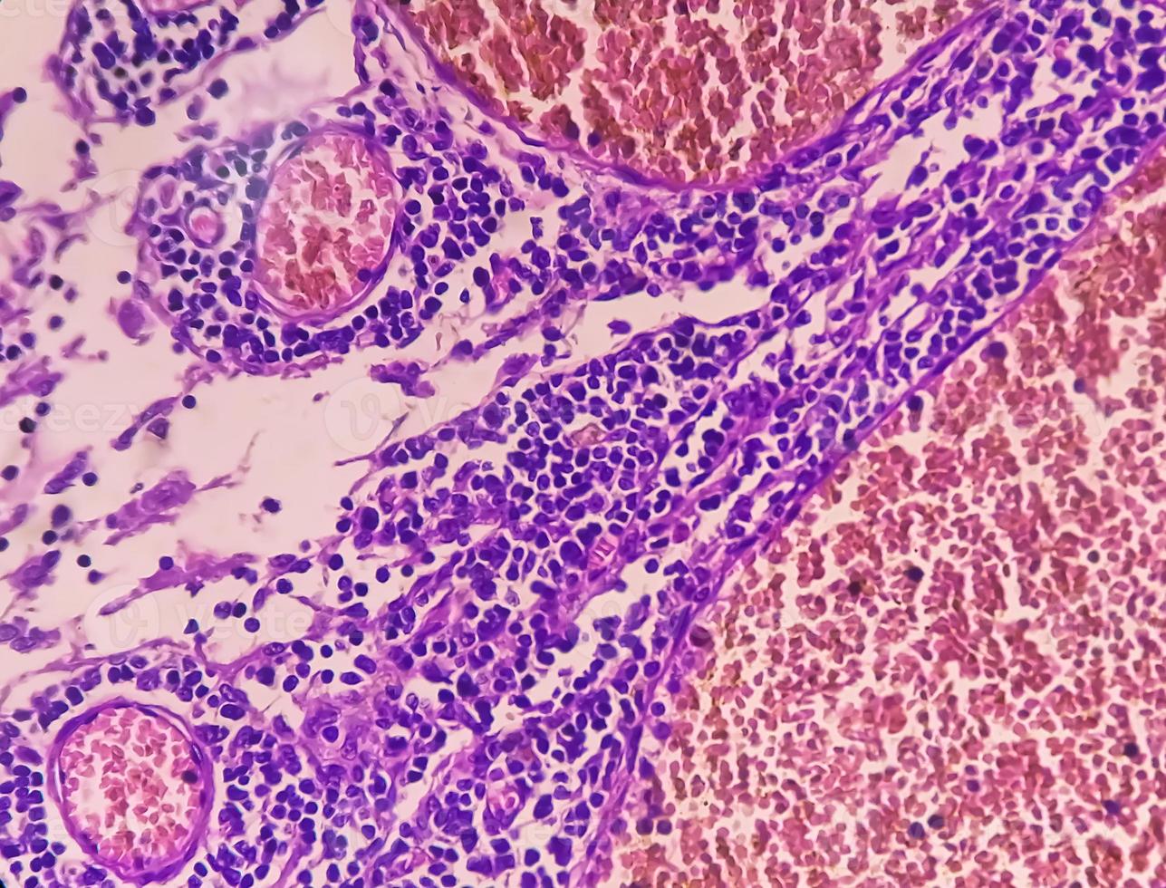 Photomicrograph of Stomach Adenocarcinoma. Gastric Adenocarcinoma. photo
