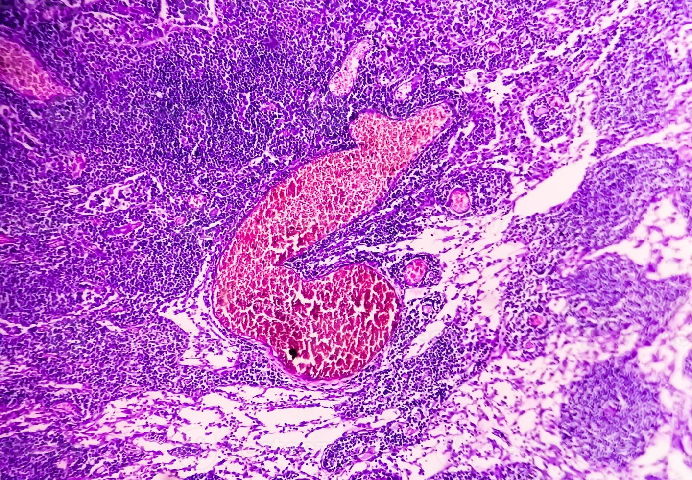 fotomicrografía de adenocarcinoma de estómago. adenocarcinoma gástrico. foto