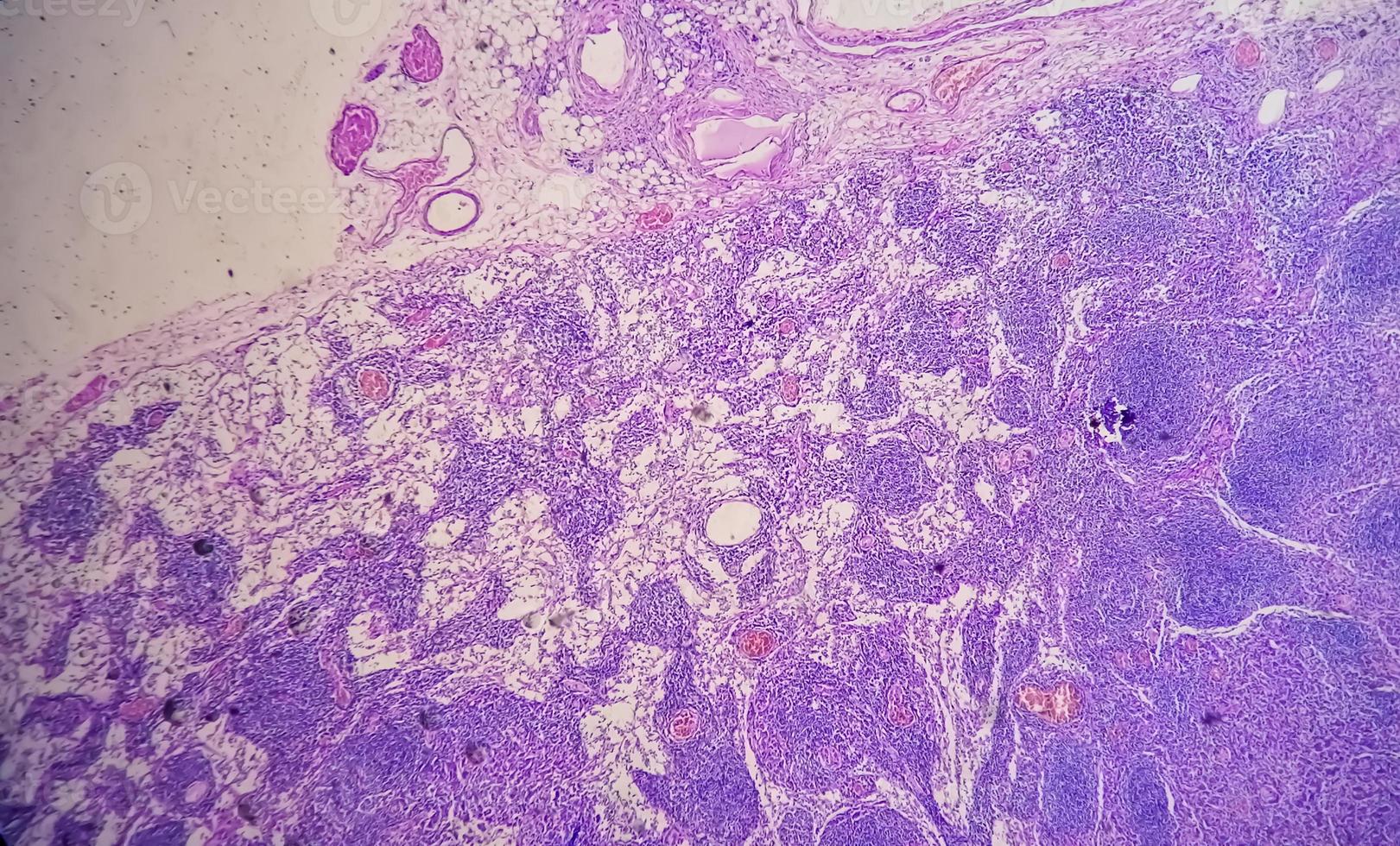 Photomicrograph of Stomach Adenocarcinoma. Gastric Adenocarcinoma. photo