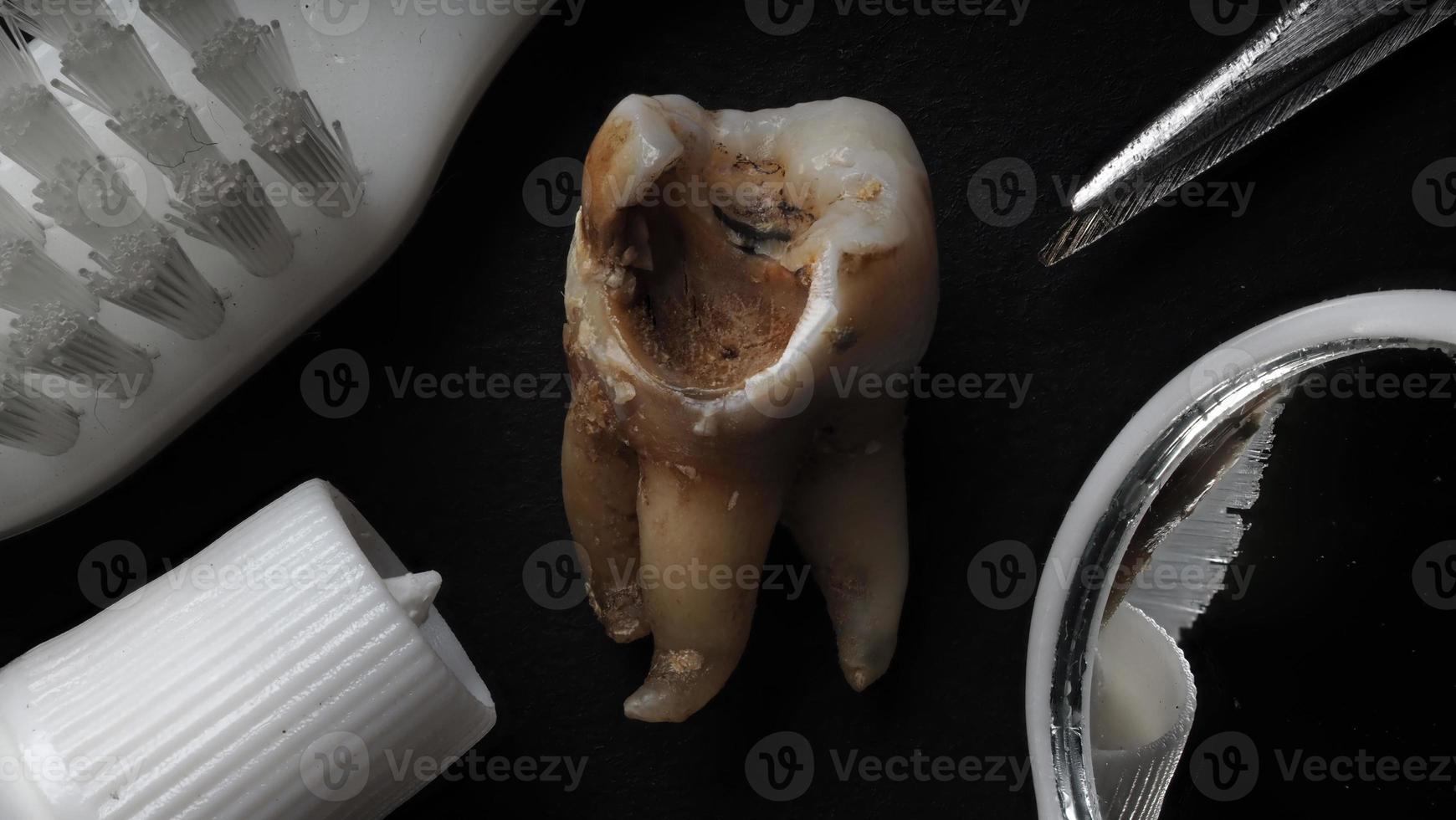 toma macro de dientes cariados hasta la raíz después de la extracción del dentista. foto