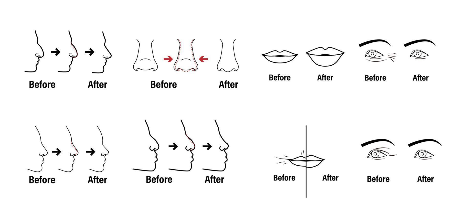 Plastic surgery and clinic with lifting plasty and liposuction sketch icons set flat isolated vector illustration.