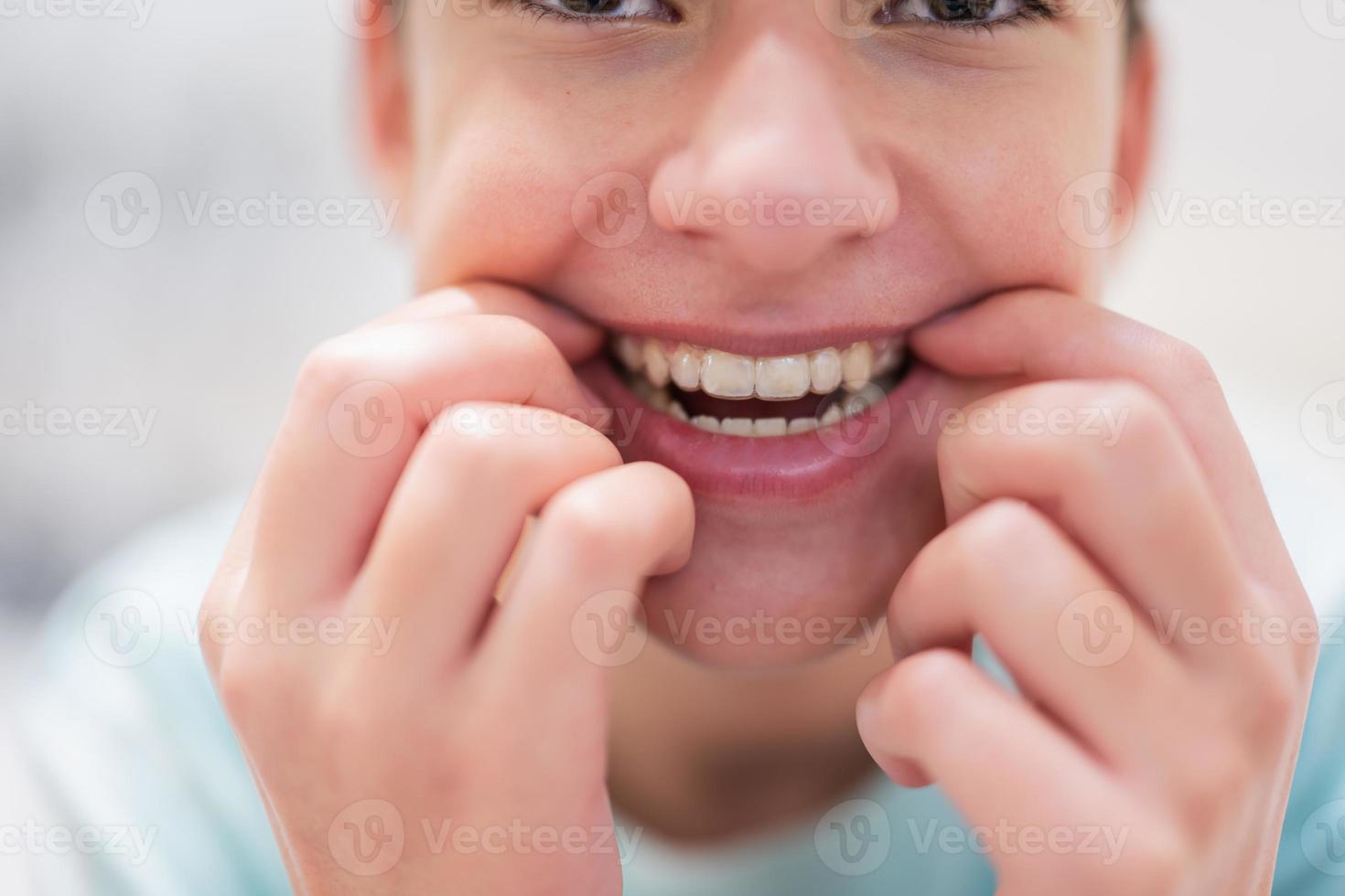 Teenager boy wear simulator orthodontic silicone invisible leveling braces for teeth.  Dental concept, orthodontics. photo