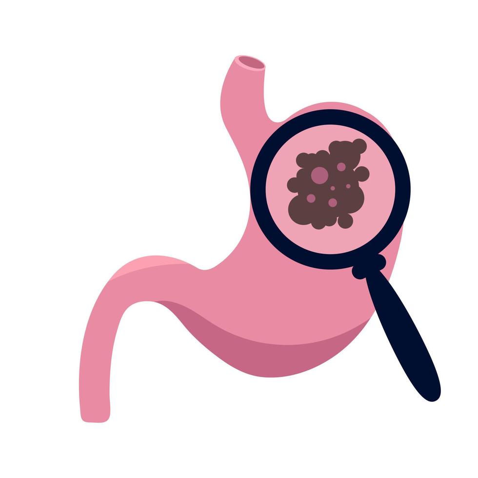 Illustrative image of stomach cancer vector