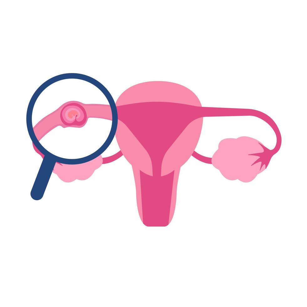Illustrative image of ectopic pregnancy vector