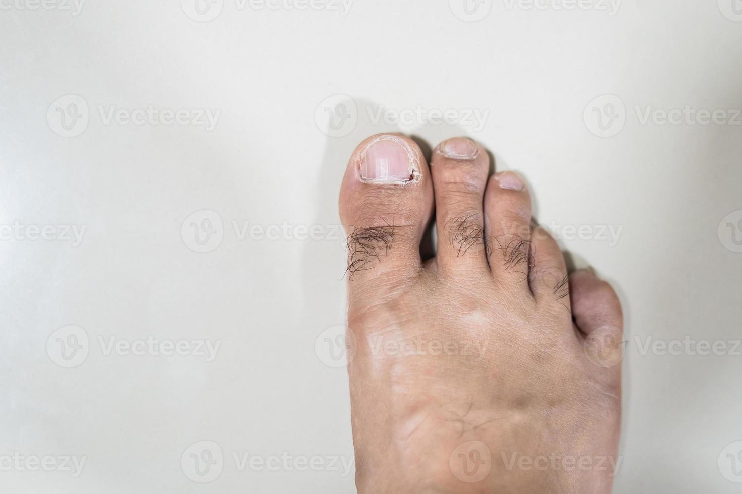 Ingrown nails is Inflamed fingernails with pus on floor. Toenail problems on gray background photo