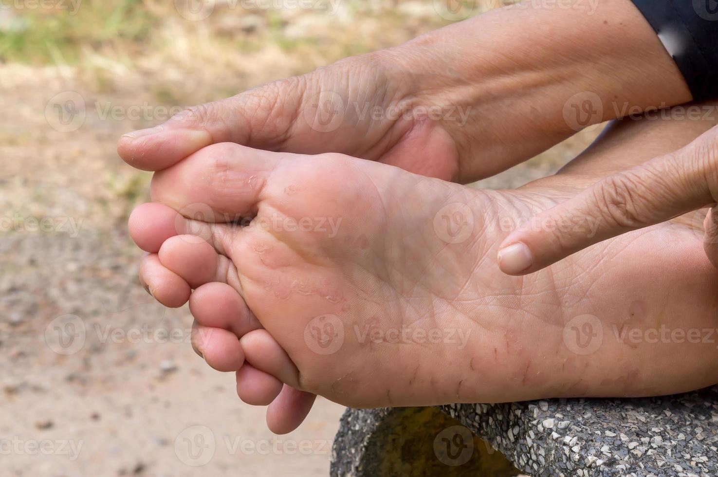 Woman hand pointing at foot sore caused by Athlete's foot, Patient