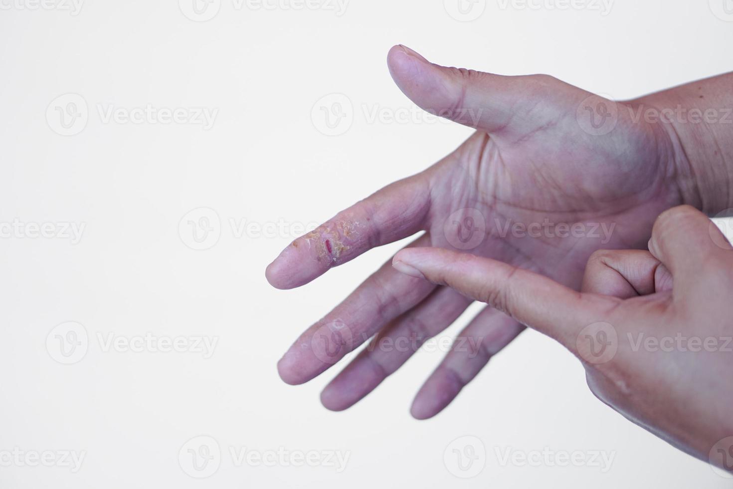 el dedo de primer plano apunta a la mano lesionada. concepto, manos malsanas, sequedad e infección, picazón, hongos, inflamación, alergia en la piel de la sustancia química. foto