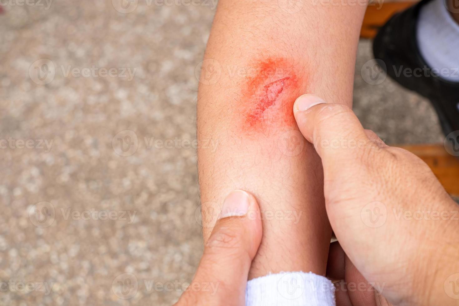 Father's hand holding baby's leg while injured leg ulcer caused by running fall, fresh wound on child's leg, health care concept photo