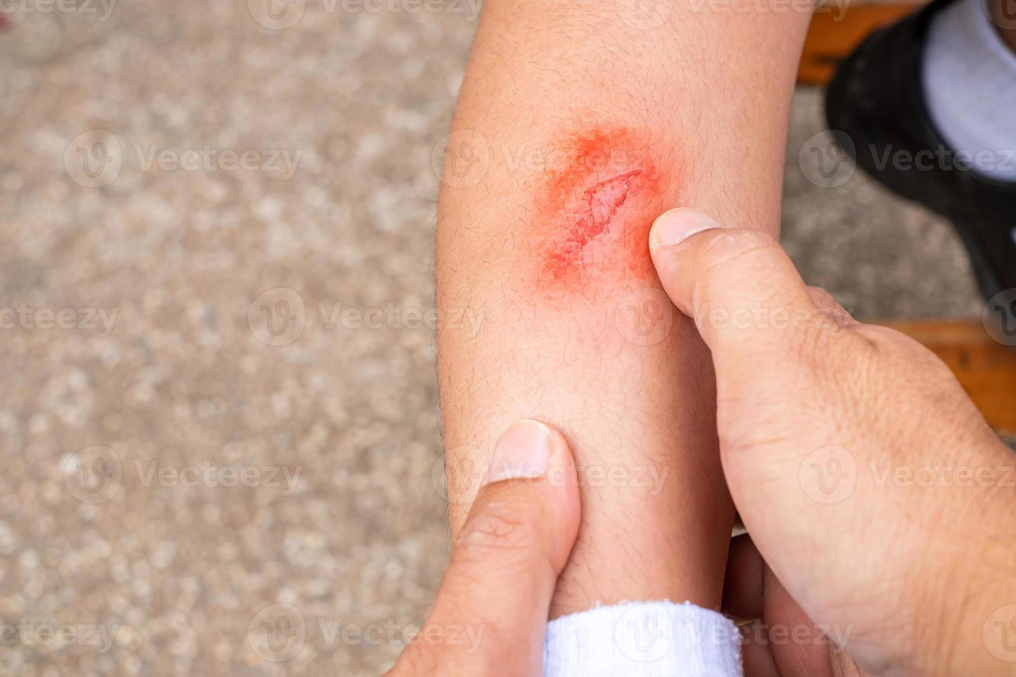 mano del padre sosteniendo la pierna del bebé mientras la úlcera de la pierna lesionada causada por una caída, herida fresca en la pierna del niño, concepto de atención médica foto