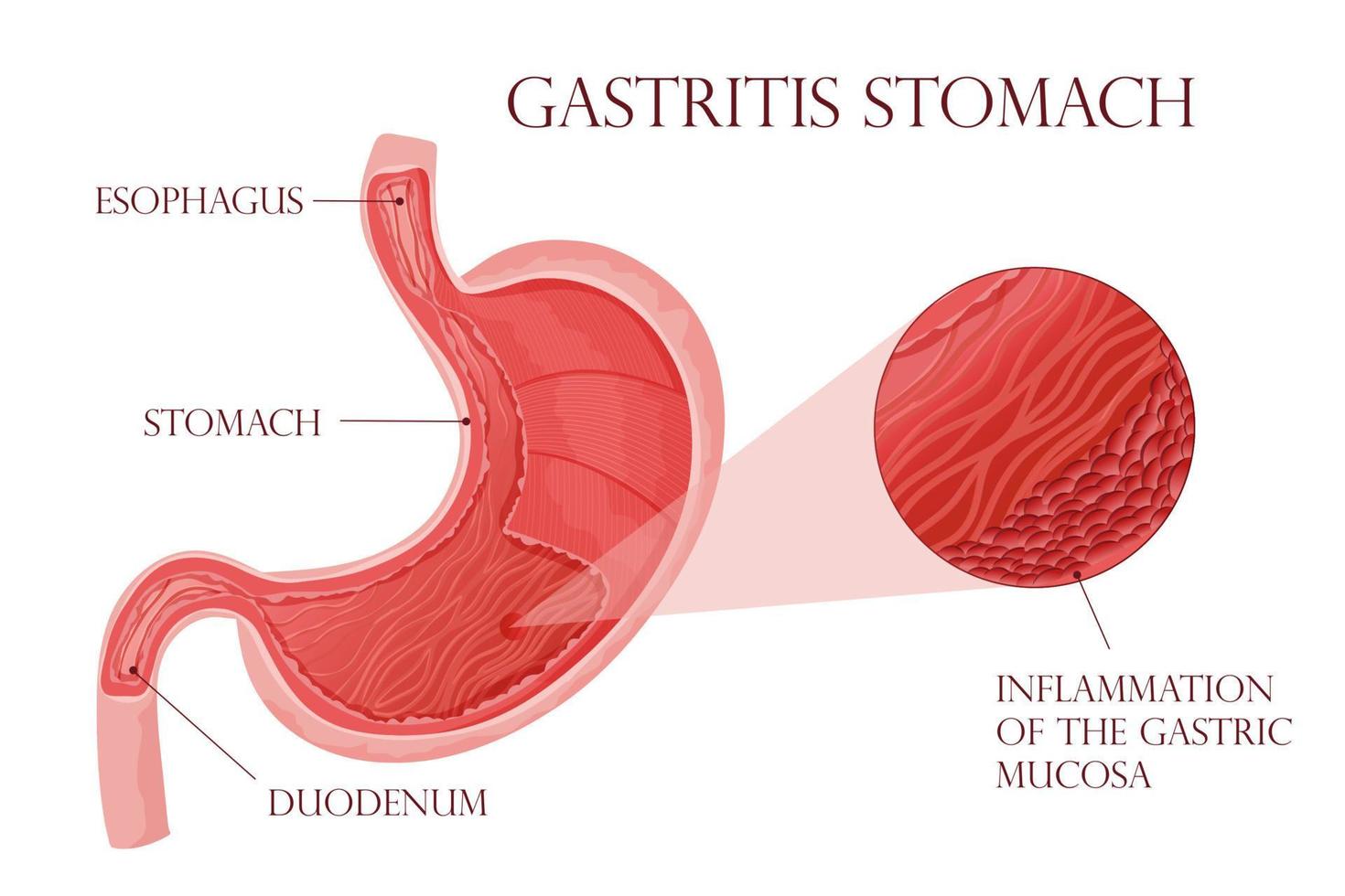 ilustración detallada inflamación en el estómago vector