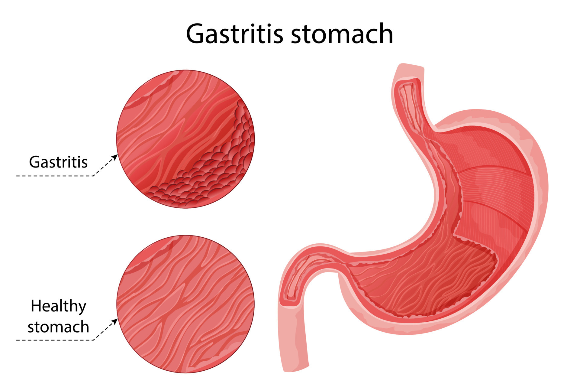 Gastritis and healthy stomach comparison infographic 17214615 Vector