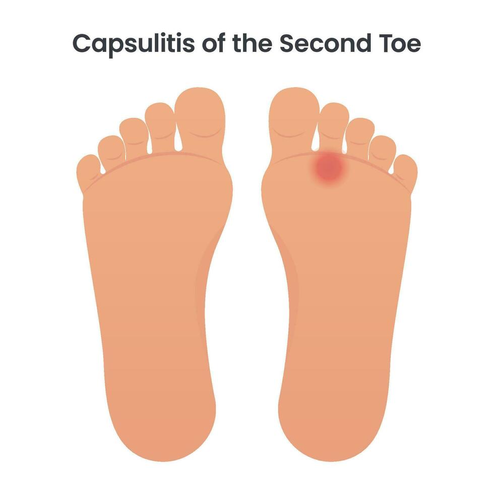 Capsulitis of the Second Toe medical vector illustration graphic