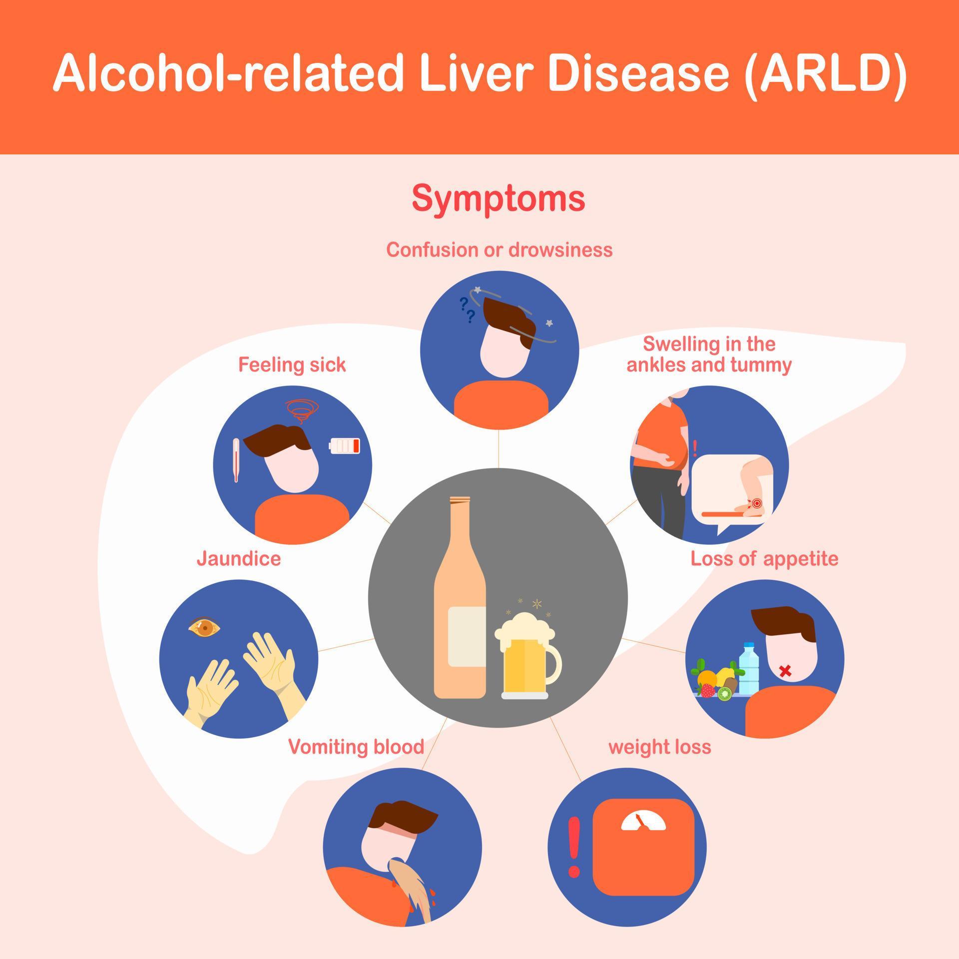 Vector illustration, infographic of alcohol related liver disease or