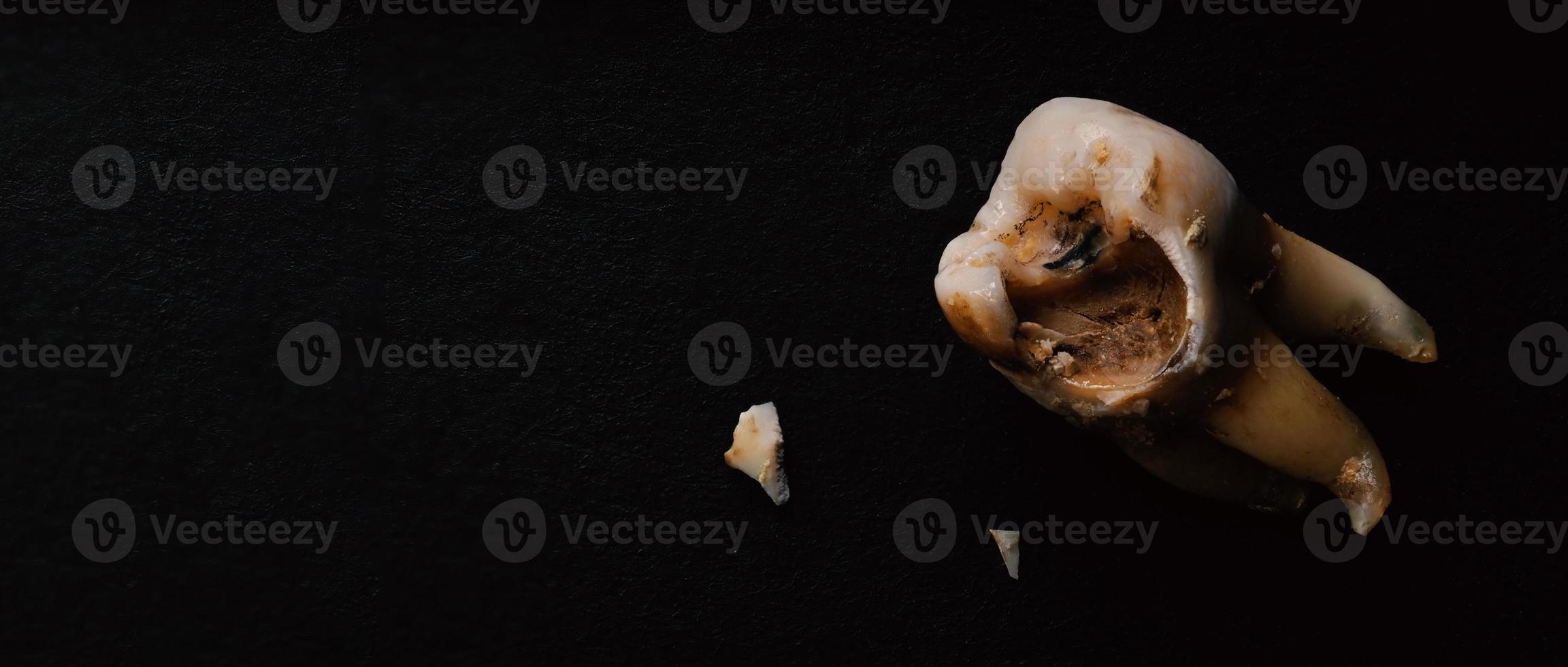 Macro shot of a decayed teeth till root after extraction of dentist. photo