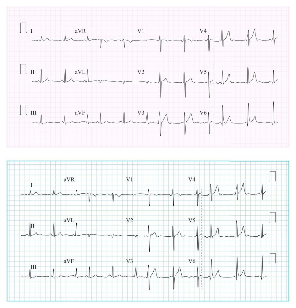 Heart Cardiogram Chart Vector. Set Healthy Heart Rhythm, Ischemia, Infarction. Vitality Heartbeat, Heart Electrocardiogram, Pulse Line vector