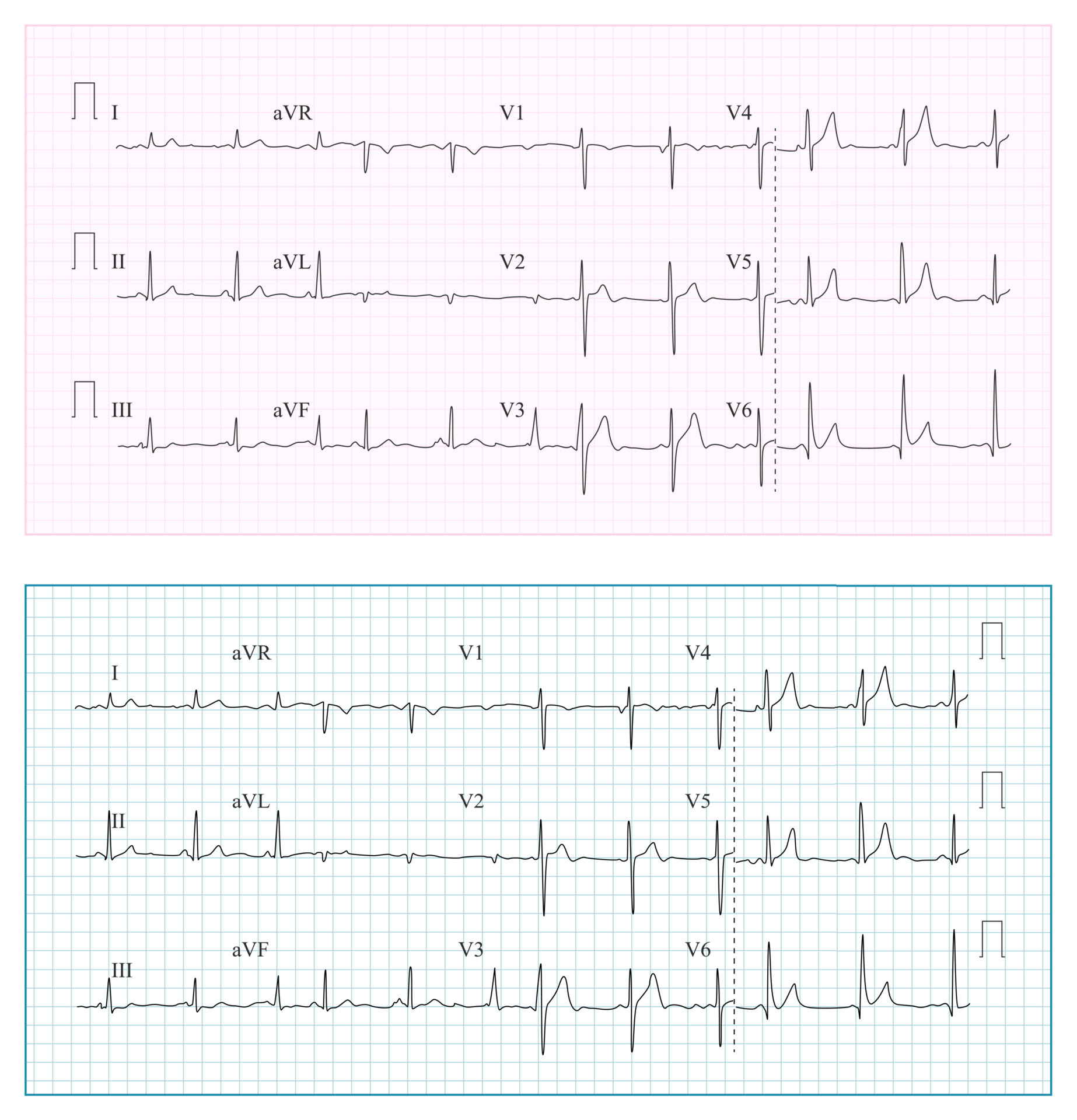 Heart Cardiogram Chart Vector. Set Healthy Heart Rhythm, Ischemia