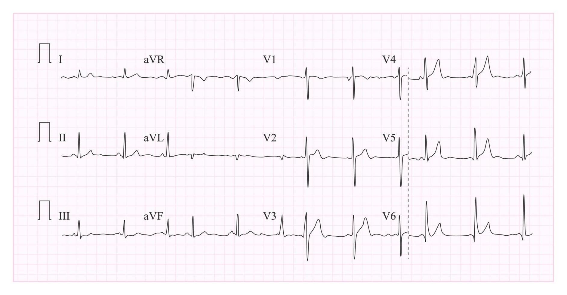 vector de gráfico de cardiograma cardíaco. ilustración de la forma de onda en el gráfico de ecg comprobado. ritmo cardiaco, isquemia, infarto. latido del corazón de vitalidad