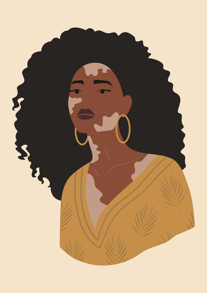 joven mujer negra con cartel de vitíligo. la belleza es diversidad. autoaceptación, concepto de amor propio. afiche, pancarta, tarjeta del día mundial del vitíligo vector