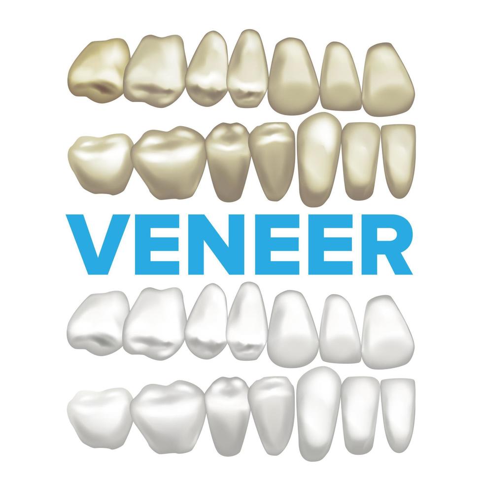 Veneer Vector. Dental Veneer Concept. Medical Banner Design Element. Tooth Before And After. Illustration vector