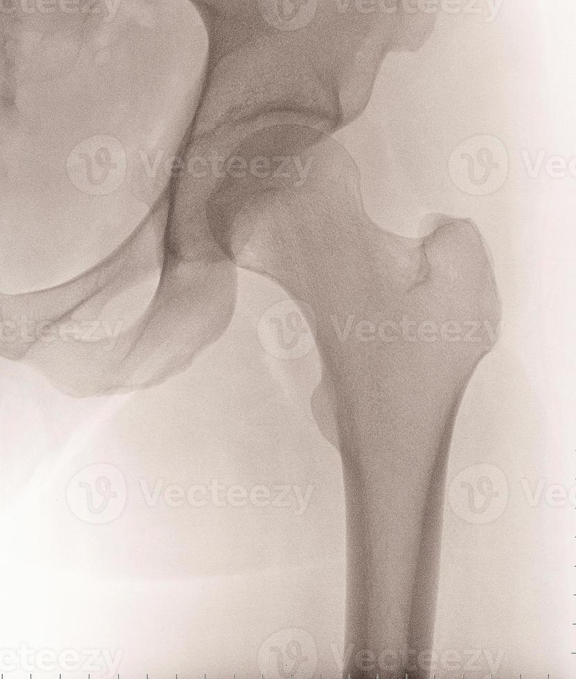Female Left Hip XRay 17402725 Stock Photo at Vecteezy