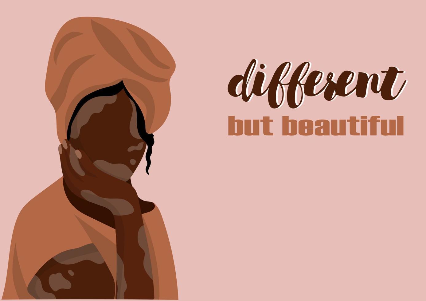 A young girl with Vitiligo skin problems vector