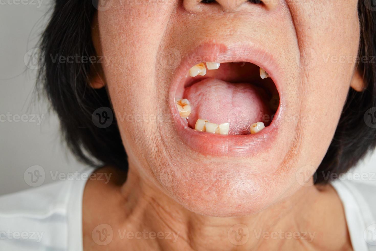 una anciana asiática sonrió y vio los dientes restantes en la boca. debido a la pérdida parcial que ocasionó la necesidad de usar dientes artificiales. el concepto de buena salud oral foto