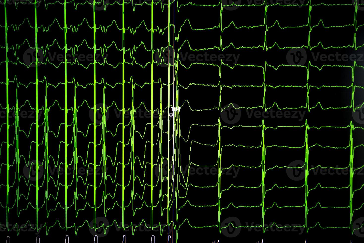 cardiograma de antecedentes médicos en el monitor. foto