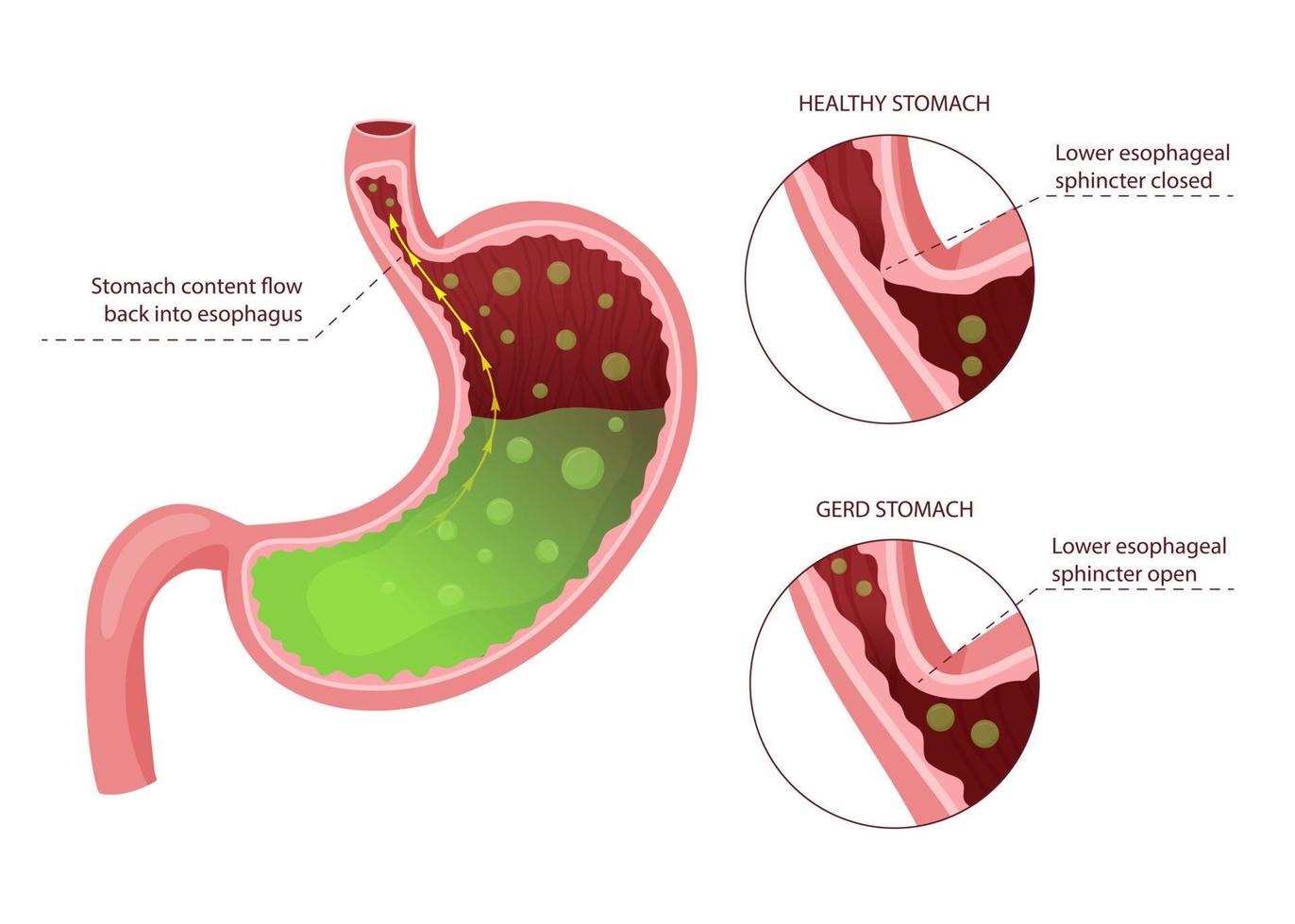 Gastroesophageal reflux disease diagram vector