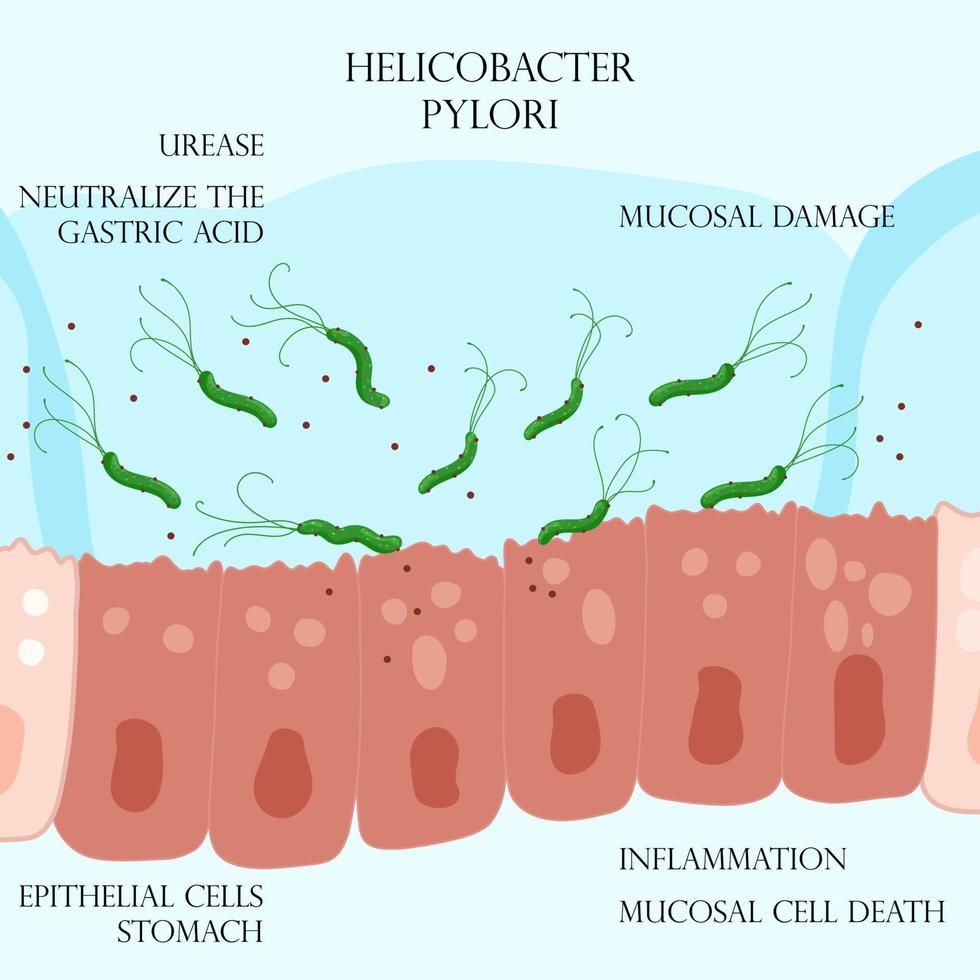 helicobacter pylori en la capa mucosa de las células epiteliales inflamadas en el estómago vector