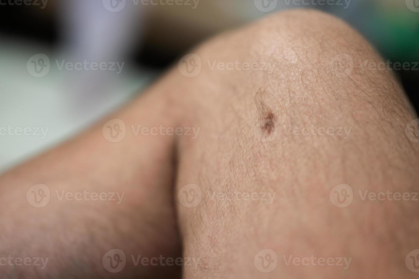 Dark brow birthmark or naevus on male leg. photo