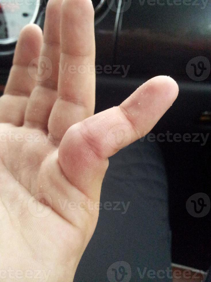 Picture of an dislocated finger ankle after sport accident photo