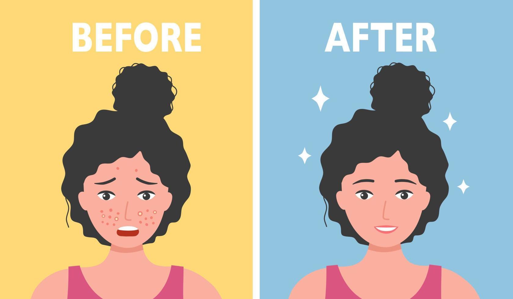 Woman face acne before and after skin care treatment in flat design. vector