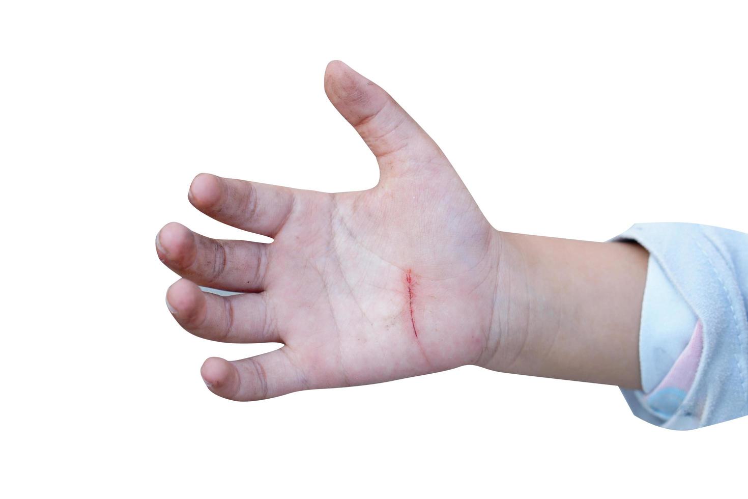 Child hand with wound on white background photo