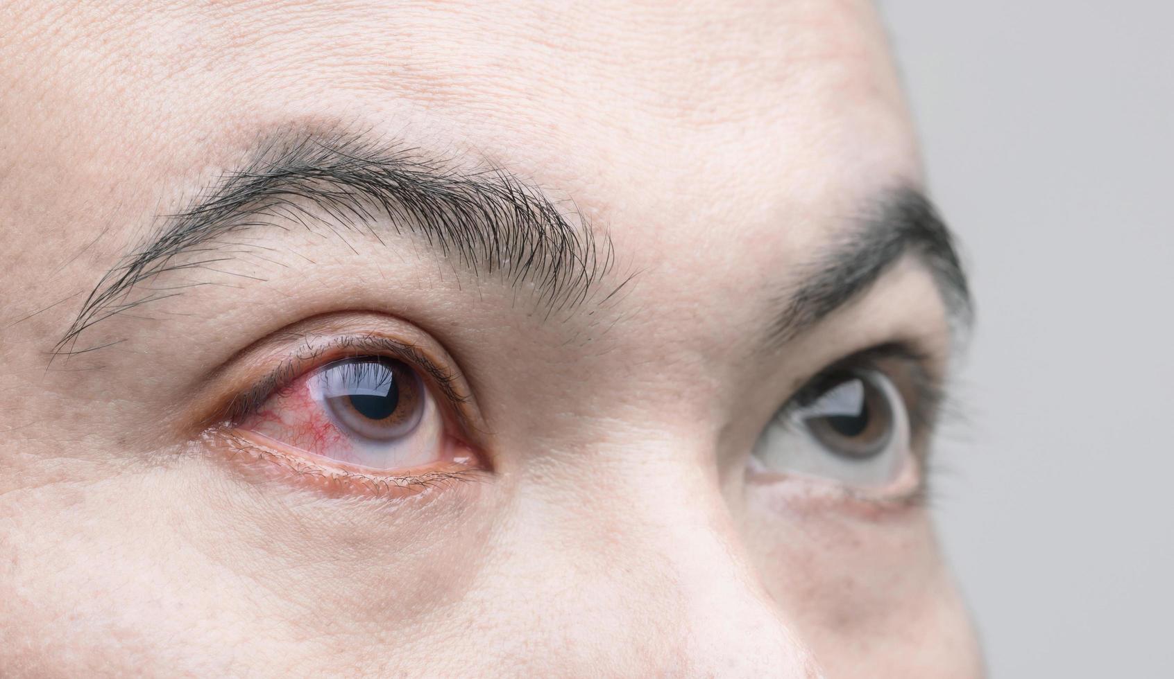 irritación ocular concepto ojo rojo del hombre, conjuntivitis ocular o después de recibir polvo foto