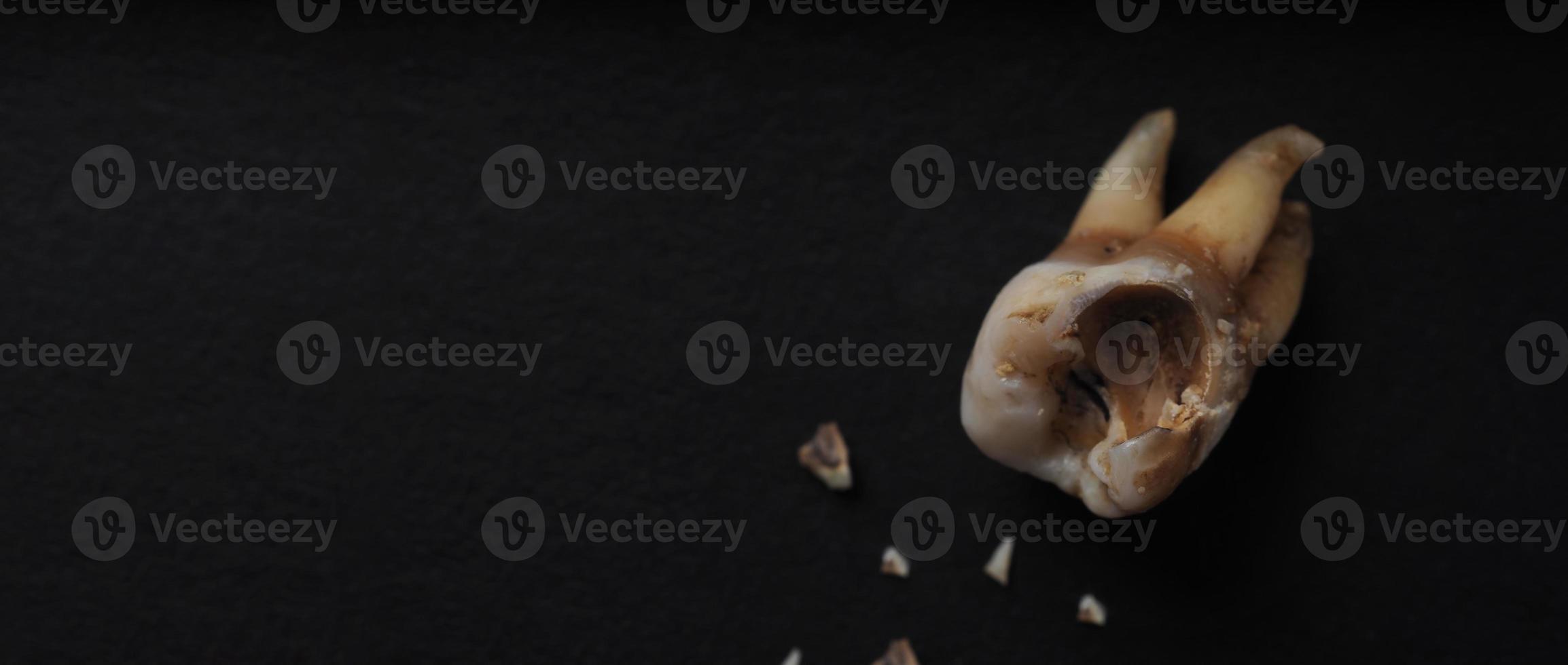 Macro shot of a decayed teeth till root after extraction of dentist. photo