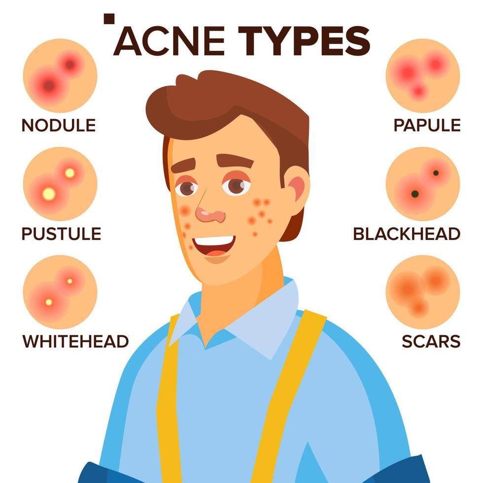 vector de tipos de acné. hombre con acné. problemas de la piel del rostro. pápulas, cicatrices de pústulas. ilustración de personaje de dibujos animados plano aislado