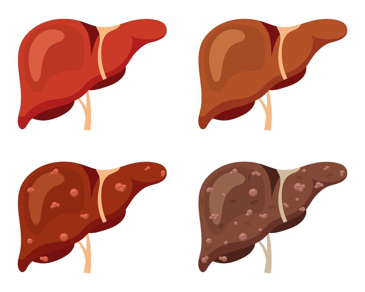 Human liver set. Stages of liver disease. Vector illustration.