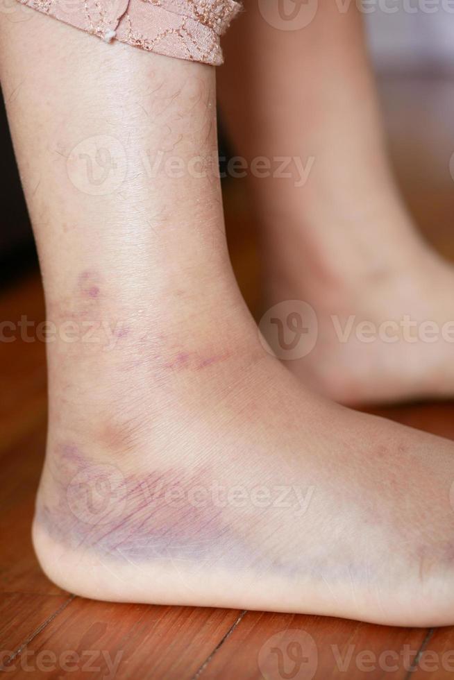 close up of women feet with swelling photo