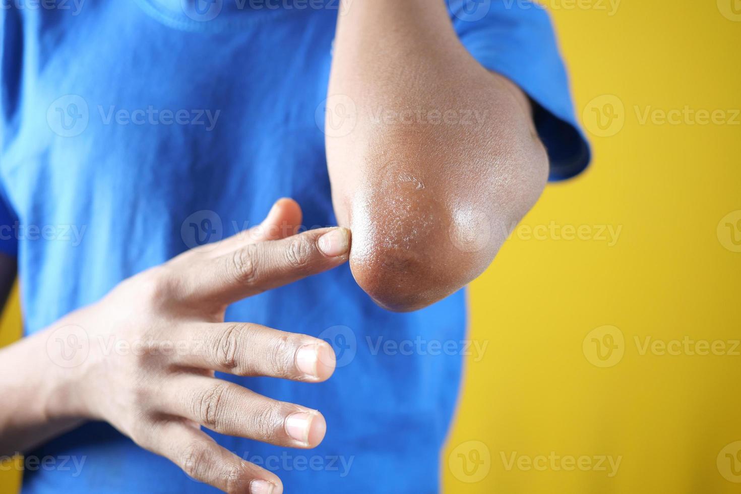 men applying petroleum jelly on elbow photo