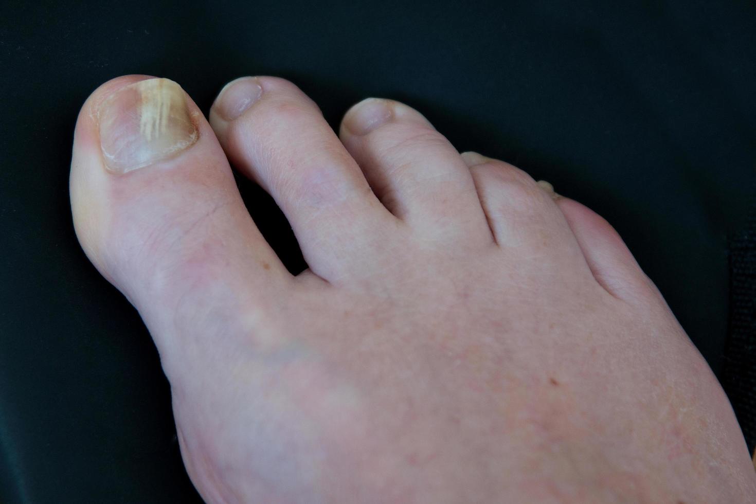 Close up of a caucasian woman right foot with toenail fungus, onychomycosis. photo