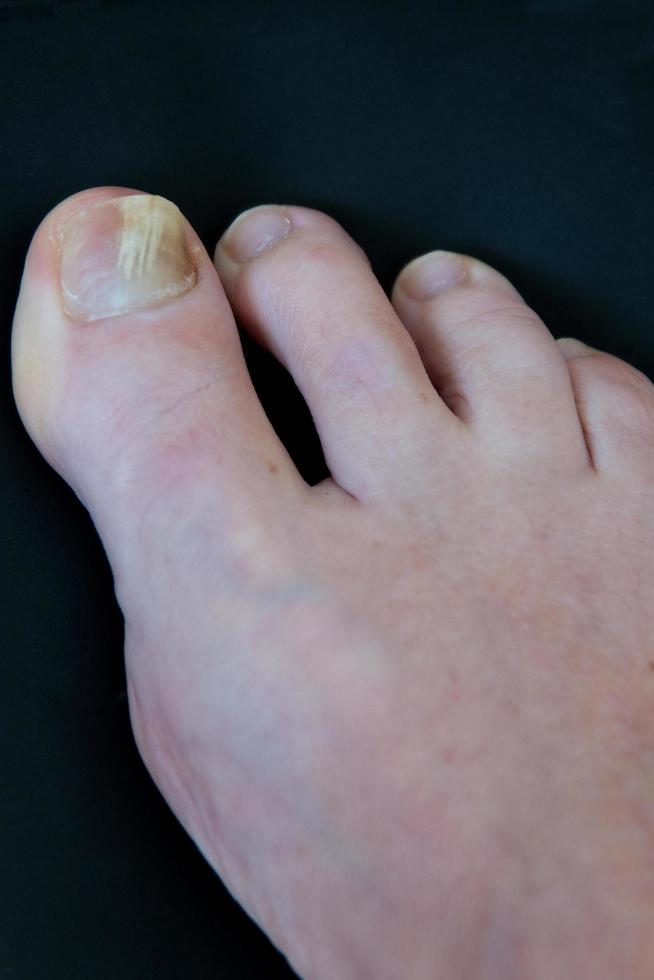 Close up of a caucasian woman right foot with toenail fungus, onychomycosis. photo